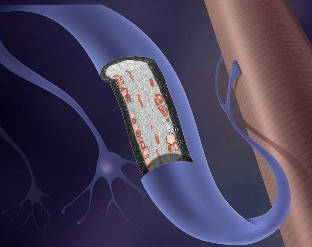  Esclorosis Lateral Amiotrófica (ELA)