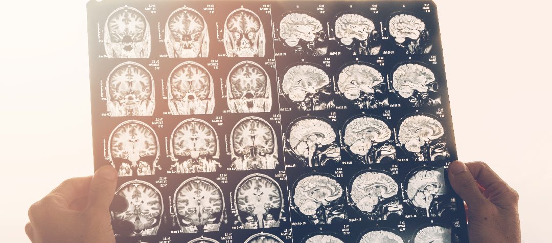 ¿Podemos contra-atacar el Alzheimer y la formación de placas seniles?