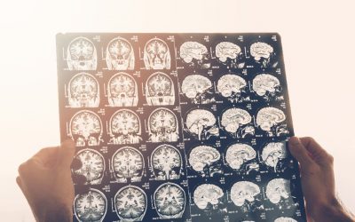 ¿Podemos contra-atacar el Alzheimer y la formación de placas seniles?