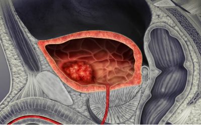 Cáncer de vejiga: síntomas, causas y pronóstico